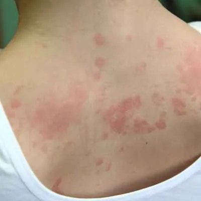 Allergische Reaktion