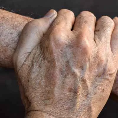 Altersflecken (Lentigines)