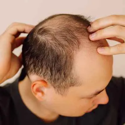 Androgenetische Alopezie