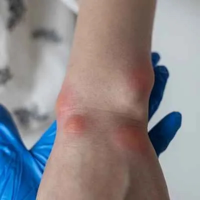 Allergisches Angioödem