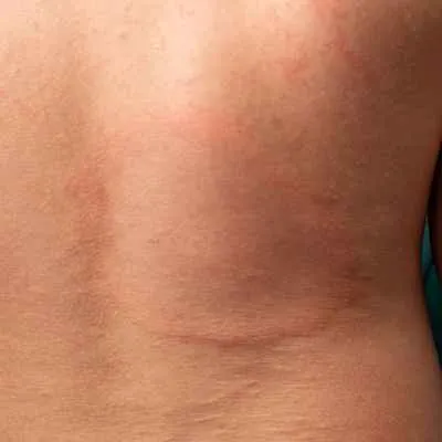 Borreliose (Wanderröte)