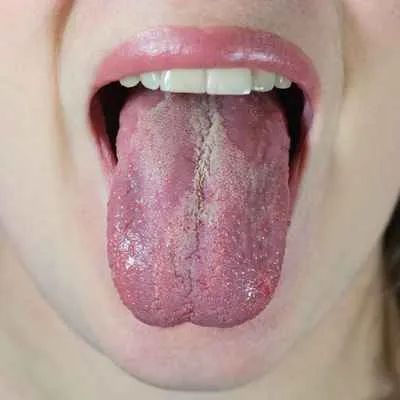 Pilzinfektion (Candida)