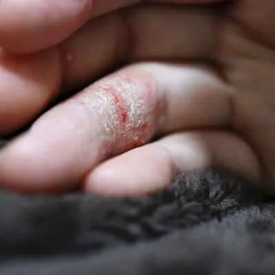 Dyshidrotisches Ekzem