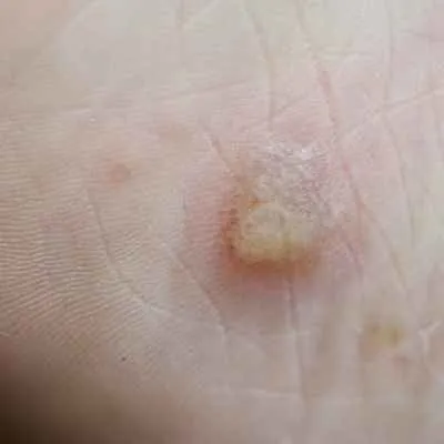 Dyshidrotisches Ekzem