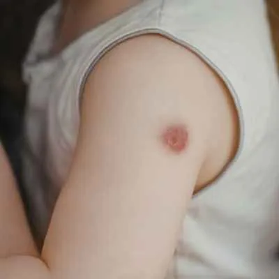 Dysplastischer Nävus