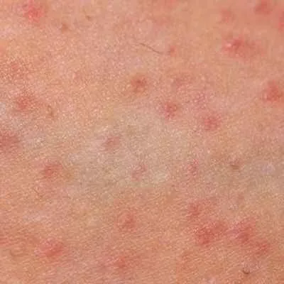 Follikulitis