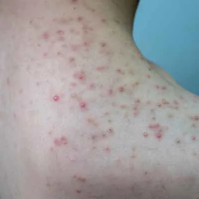 Follikulitis