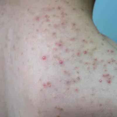 Follikulitis