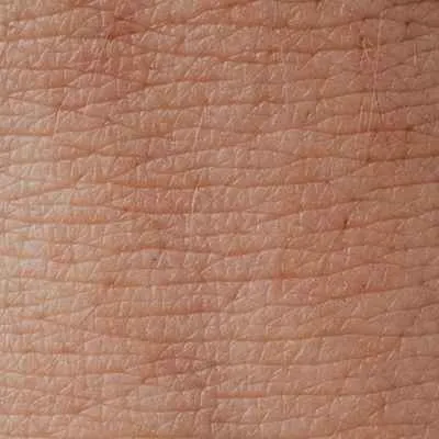 Gürtelrose (Zoster)