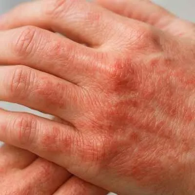 Kumulativ-toxisches Handekzem