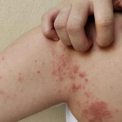 Impetigo (Grindflechte)