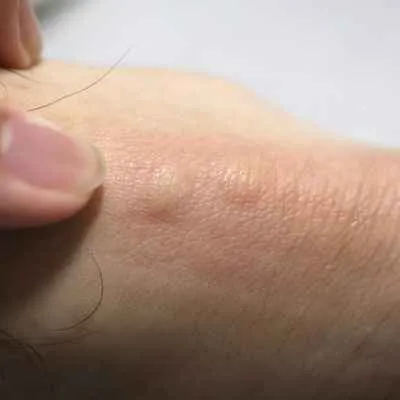 Insektenstiche (Floh/Wanze)