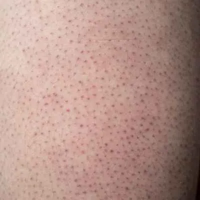 Keratosis pilaris