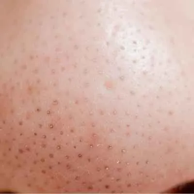 Offener Komedo (Mitesser)