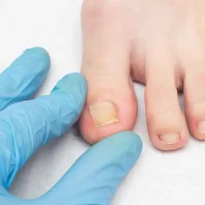 Nagelpilz (Onychomykose)