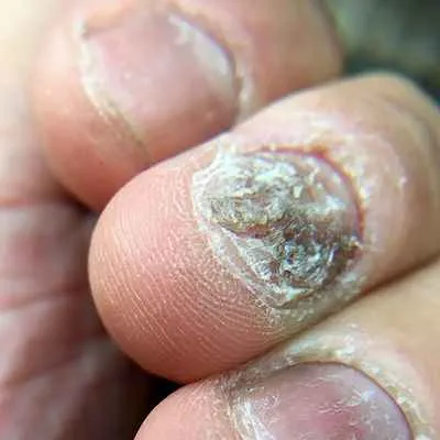 Nagelpsoriasis