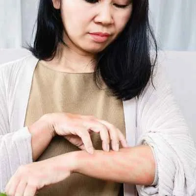 Nesselsucht (Urtikaria)