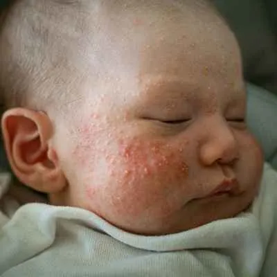 Neugeborenenakne
