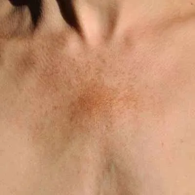 Postinflammatorische Hypopigmentierung