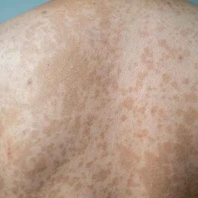 Pityriasis versicolor