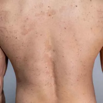 Pityriasis versicolor (Pilz)