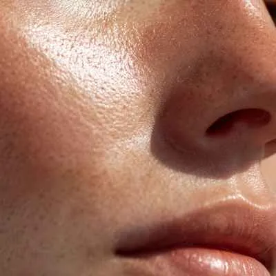 Polymorphe Lichtdermatose