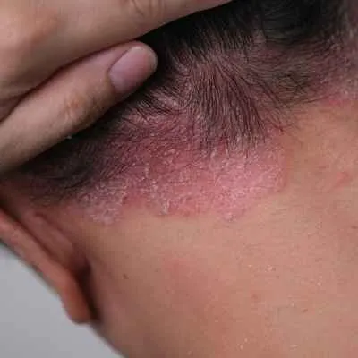 Schuppenflechte (Psoriasis)