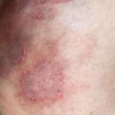 Ringelflechte (Tinea corporis)