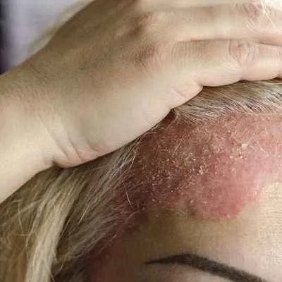 Seborrhoisches Ekzem