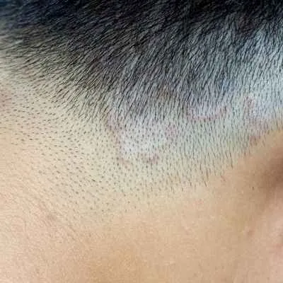 Tinea capitis (Pilz)