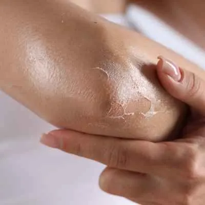 Xerosis cutis (Trockene Haut)