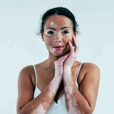 Vitiligo (Weißfleckenkrankheit)